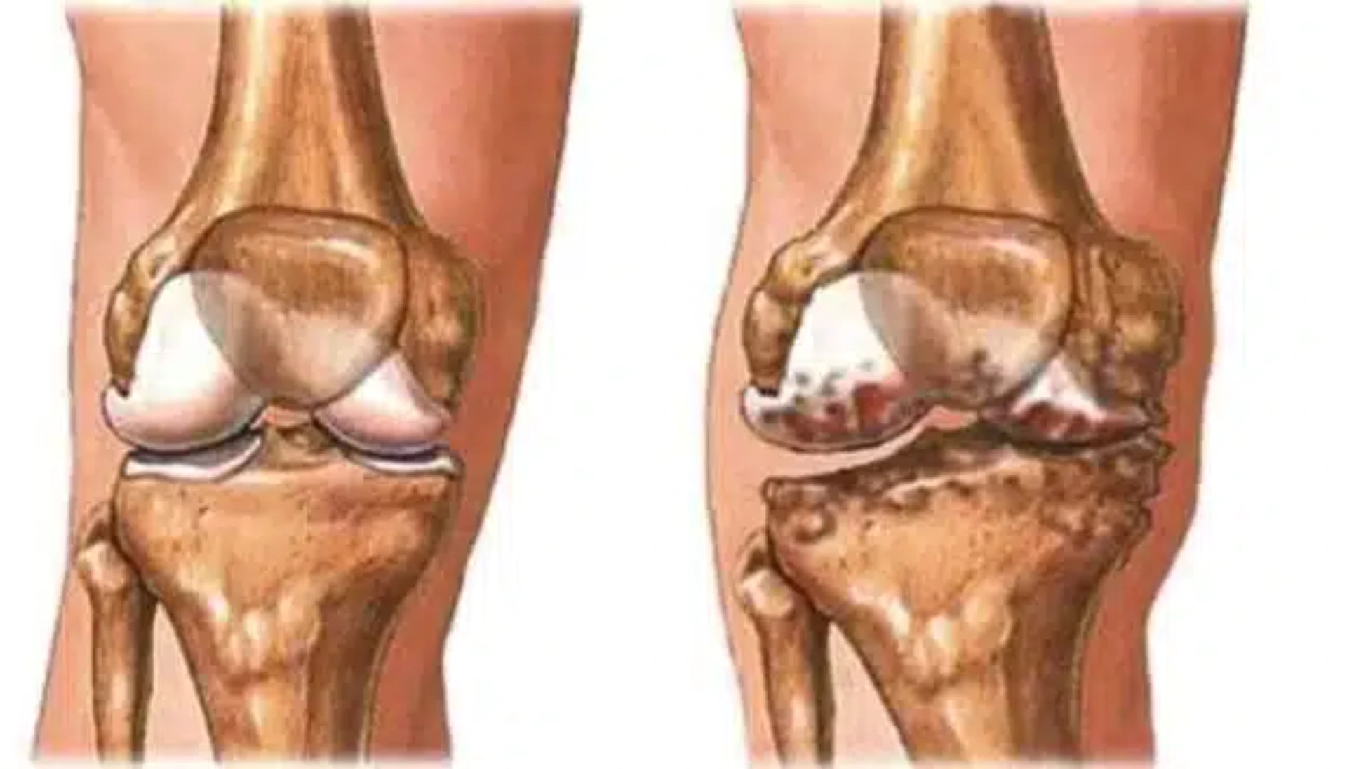 Diz Kireçlenmesi – Gonartroz(Osteoartrit)