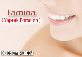 Lamina ( Yaprak Porselen )