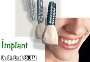 İmplant
