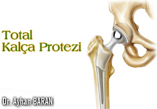 Total kalça protezi uygulaması
