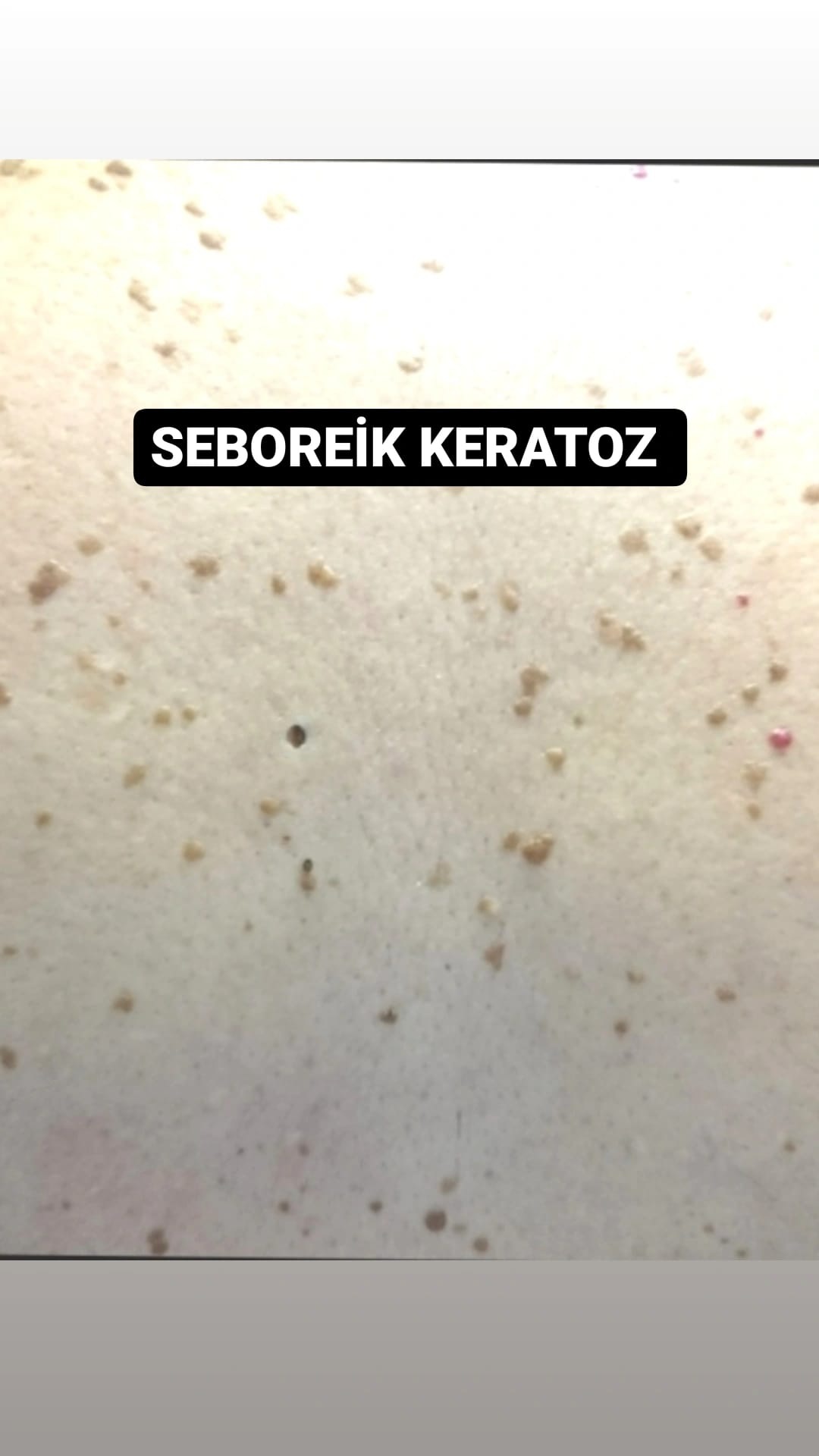 SEBOREİK KERATOZ