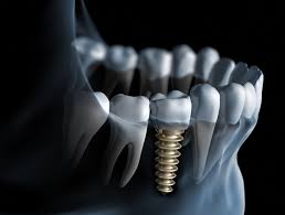 Diş implantları ! makalesi