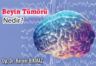 Beyin tümörü nedir?