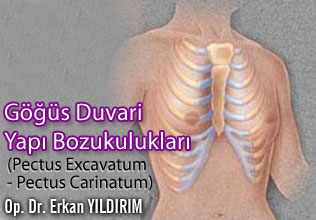 Göğüs duvarı yapı bozuklukları (pectus excavatum - pectus carinatum)