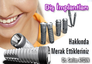 Diş implantları hakkında merak ettikleriniz!