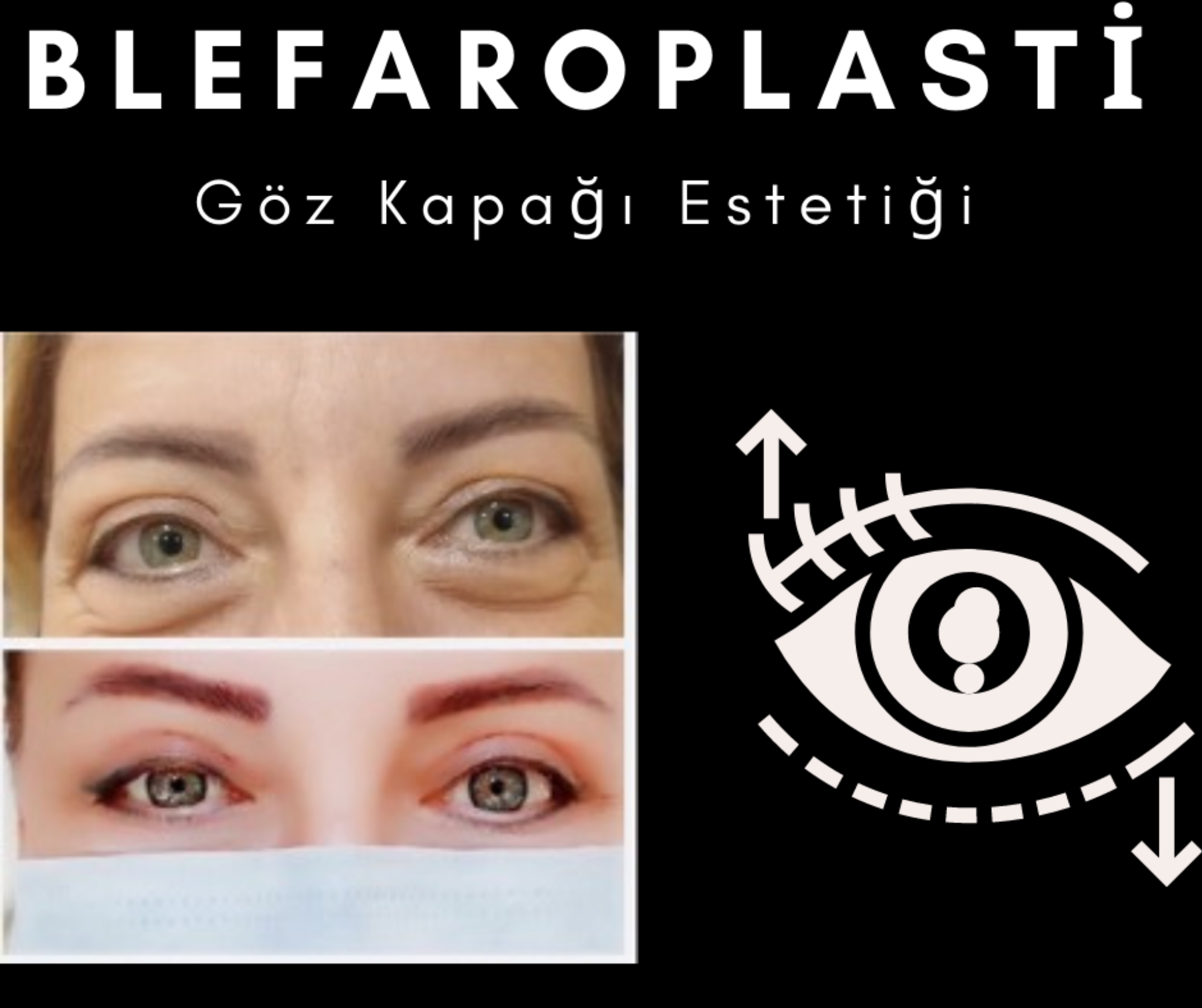 Blefaroplasti (Göz kapağı estetiği)