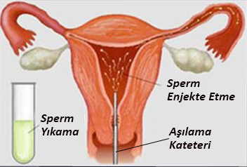 Aşılama ( İnrtauterin İnseminasyon ) Tedavisi Hangi Çiftlere Uygulanabilir ?