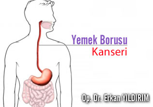 Yemek borusu kanseri hakkında merak edilenler