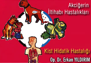 Akciğerin iltihabı hastalıkları kist hidatik hastalığı