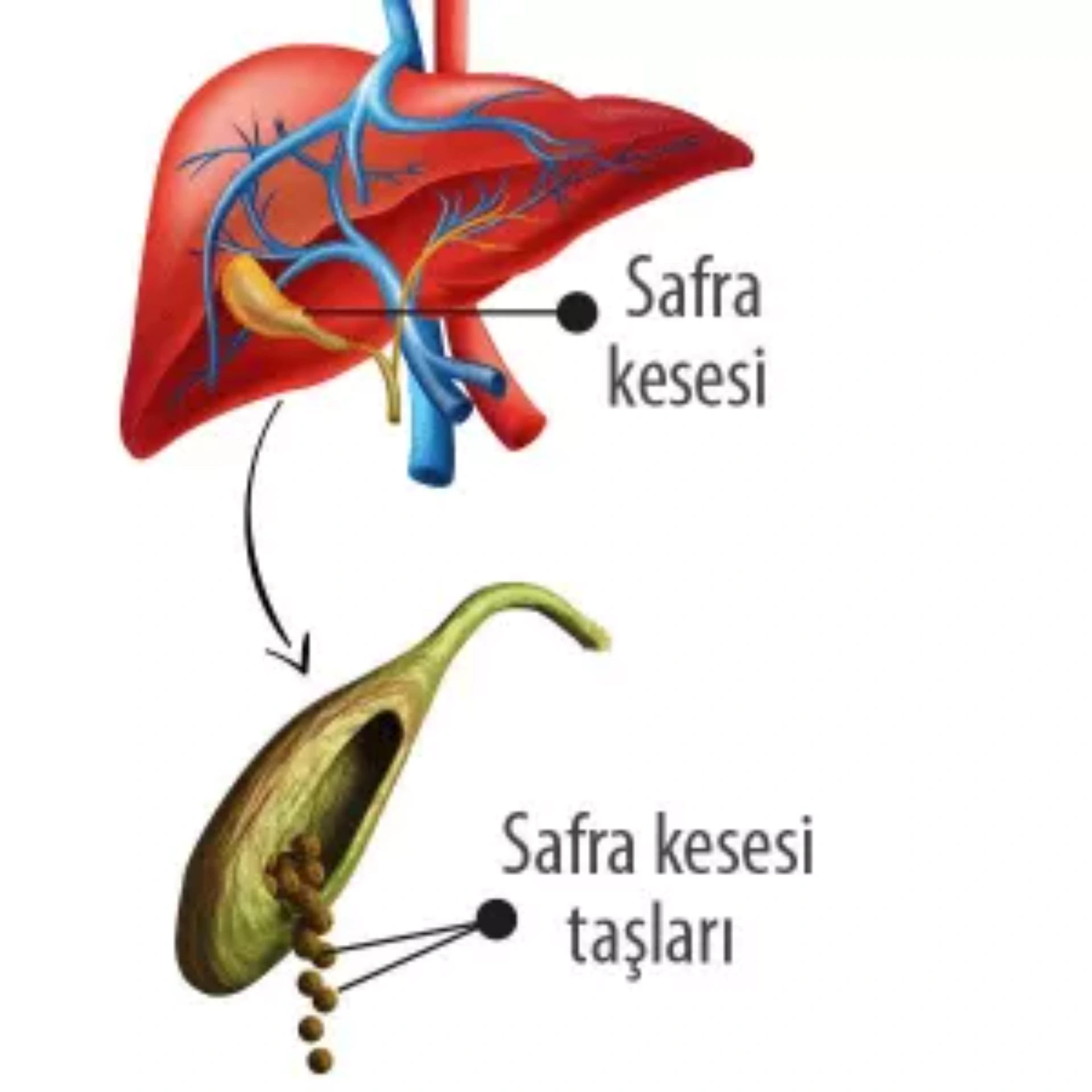 SAFRA KESESİ TAŞININ TEDAVİ YÖNTEMİ CERRAHİDİR!
