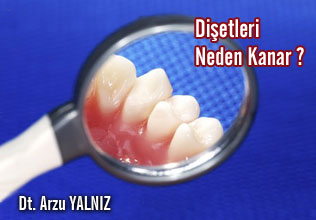 Dişetleri neden kanar ?