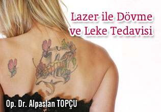 Lazer ile dövme ve leke tedavisi