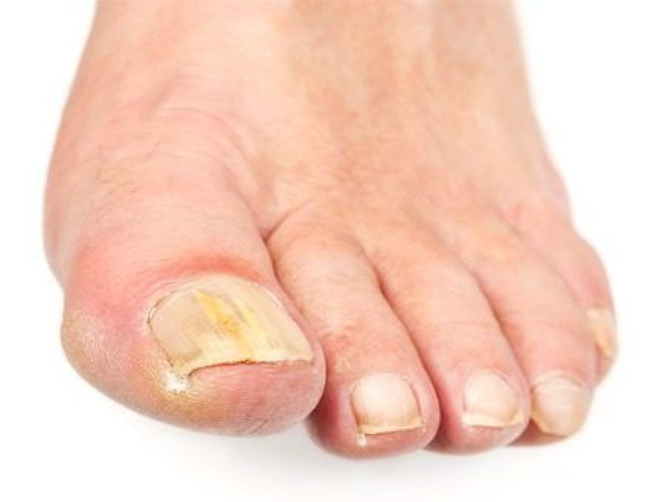 Sarı Tırnak Görünce Hemen “Mantar!” mı Demeliyiz? 😳💅🍄