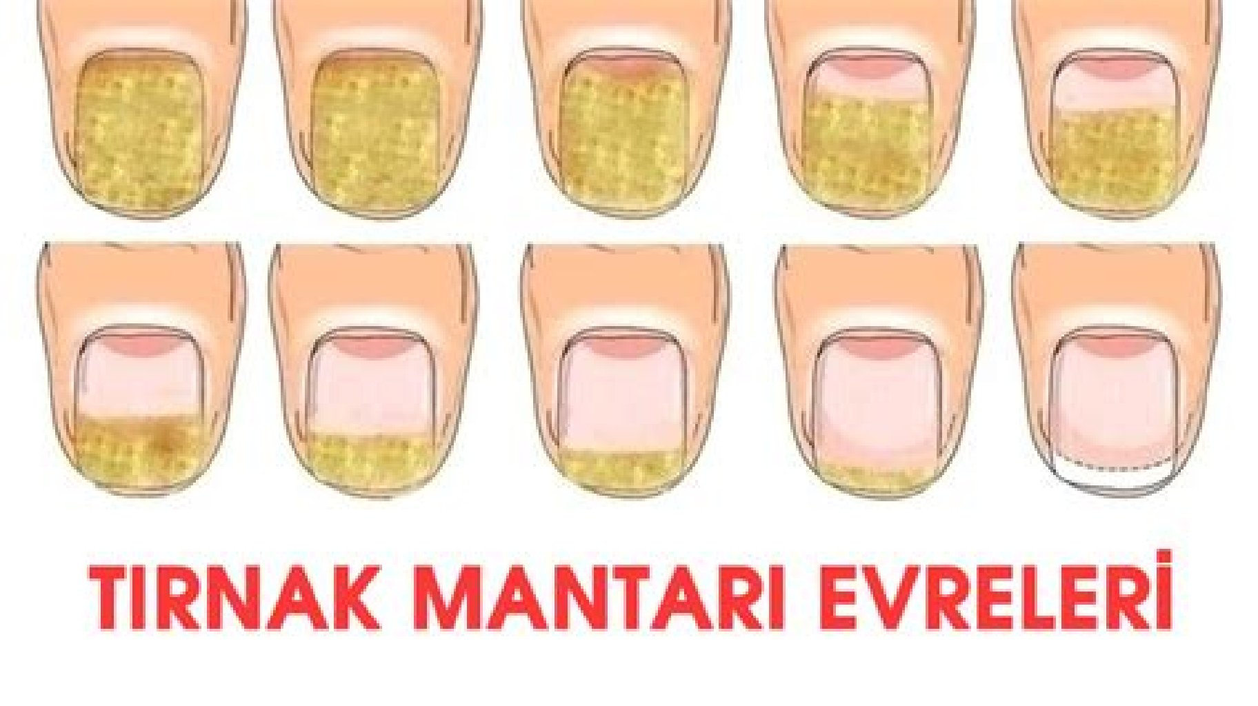 Mantarlı Tırnak