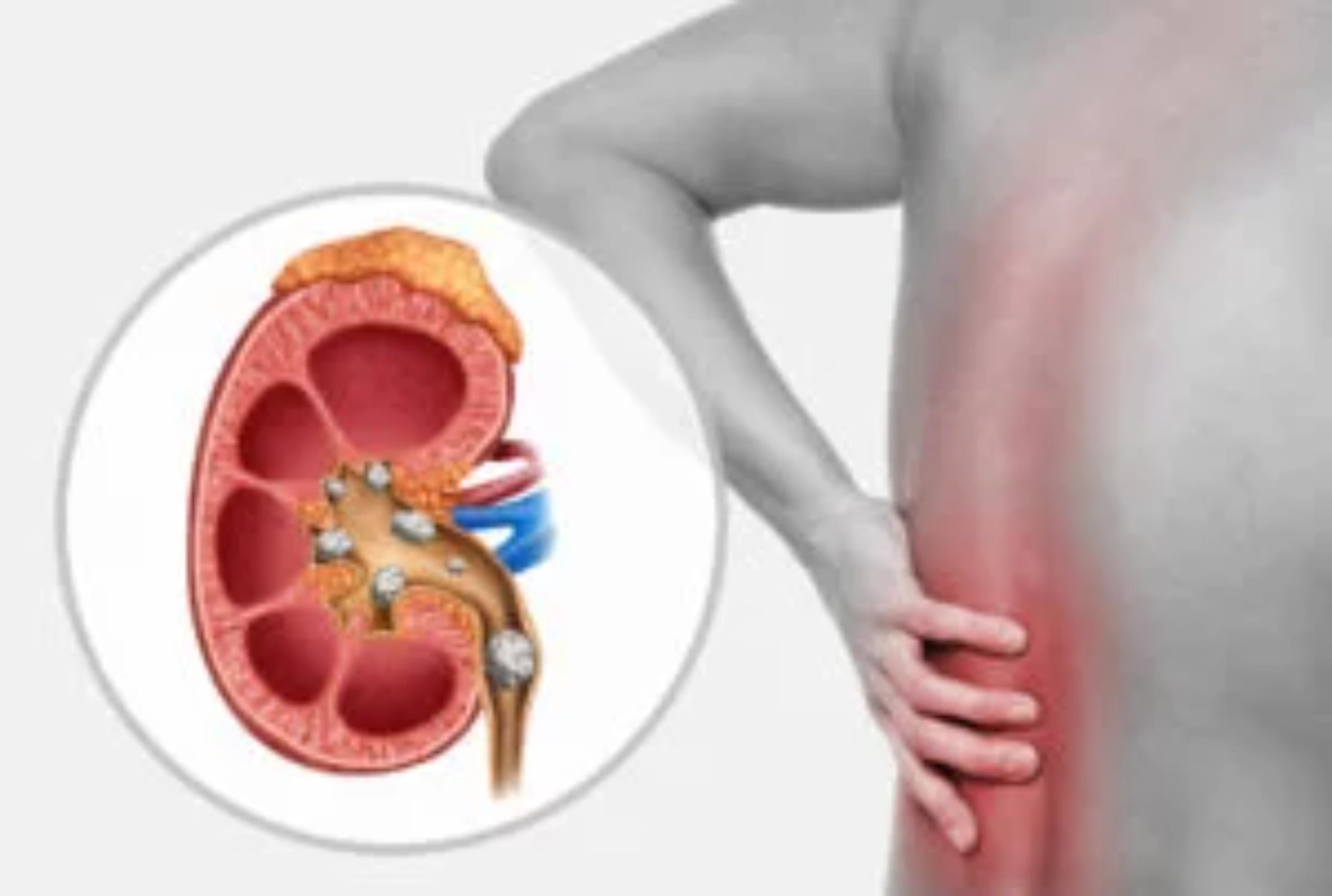 Böbrek Taşı Nedir? makalesi