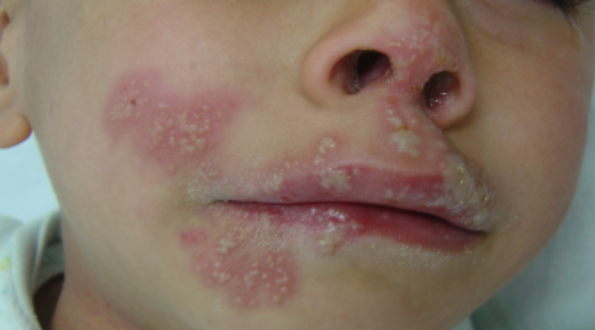 HERPES VİRÜS ENFEKSİYONLARI