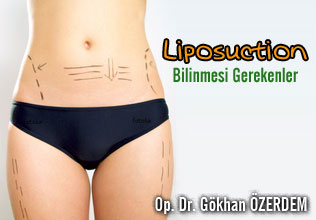 Liposuction hakkında bilinmesi gerekenler