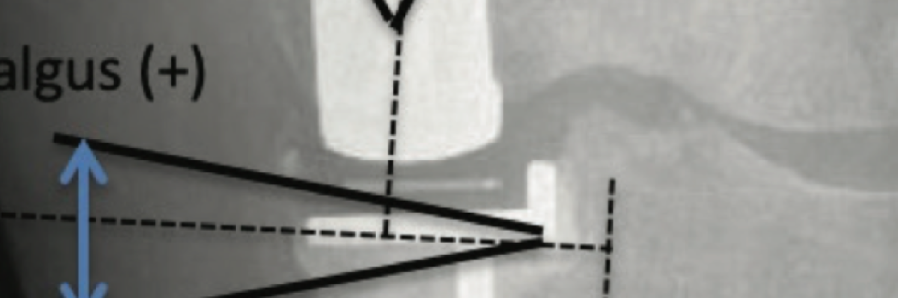 Oxford Unicondylar Knee Arthroplasty Hybrid and Cementless Fixation: Is There Any Difference in Short-term Follow-up?