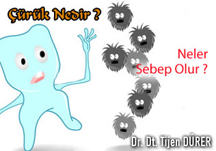 Çürük nedir ve neden olur ?