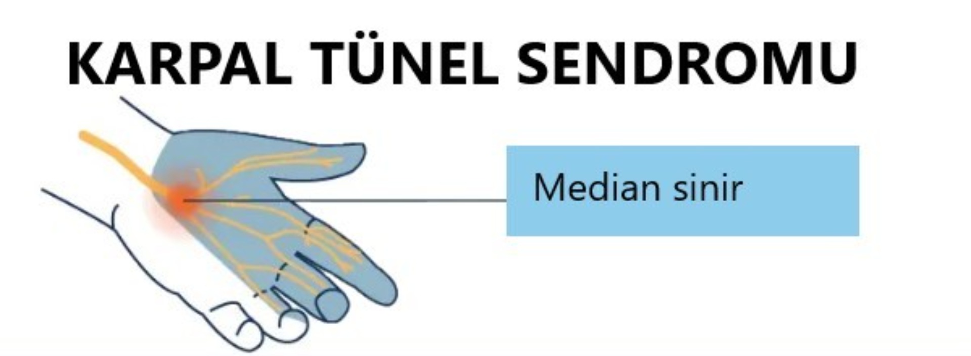 KARPAL TÜNEL SENDROMU, KTS
