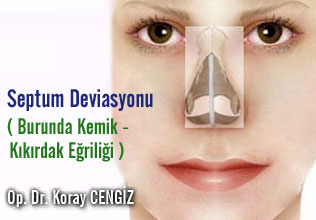 Septum Deviasyonu ( Burunda Kemik - Kıkırdak Eğriliği ) makalesi