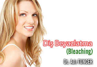 Diş Beyazlatma(Bleaching) makalesi
