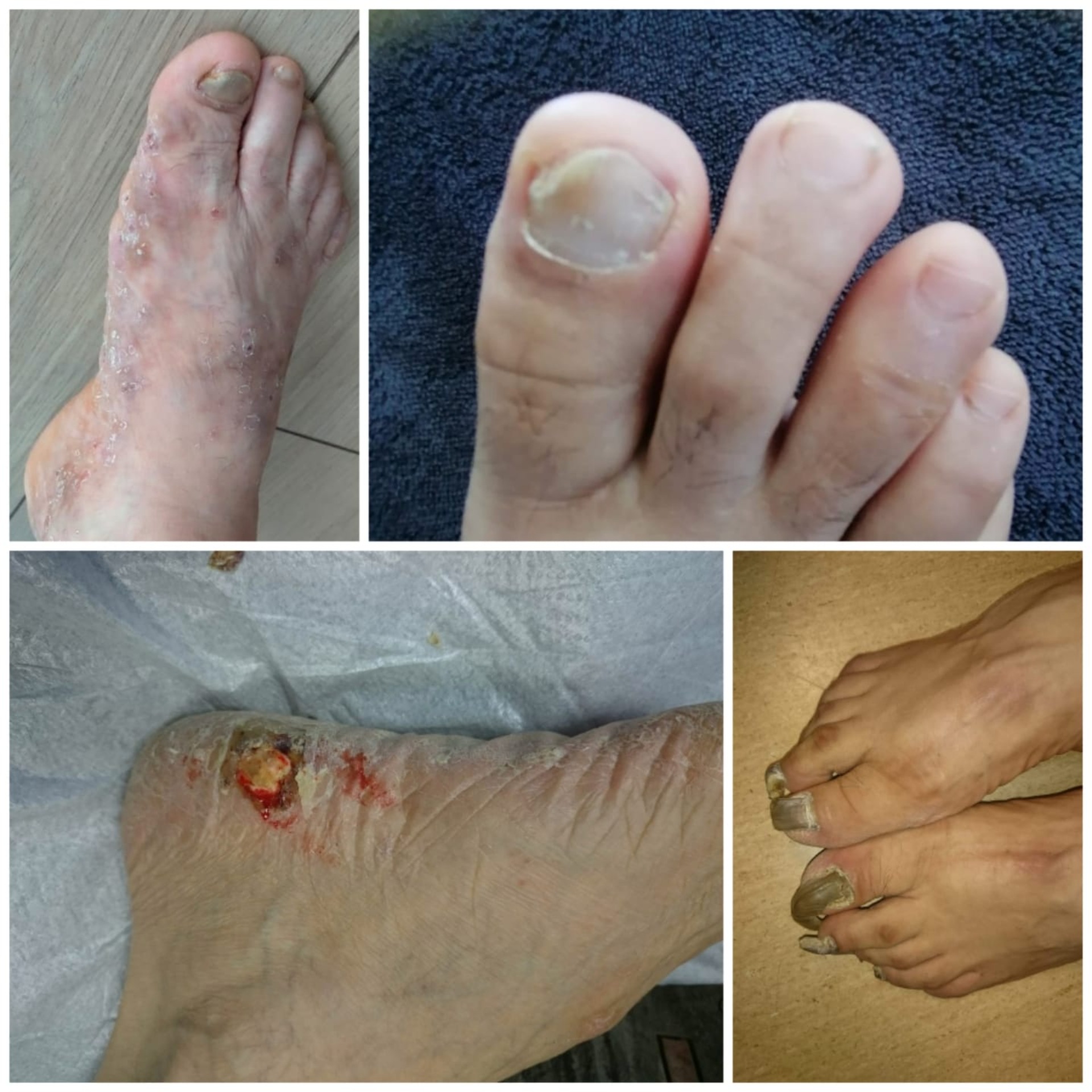 TİNEA PEDİS yani AYAK MANTARI