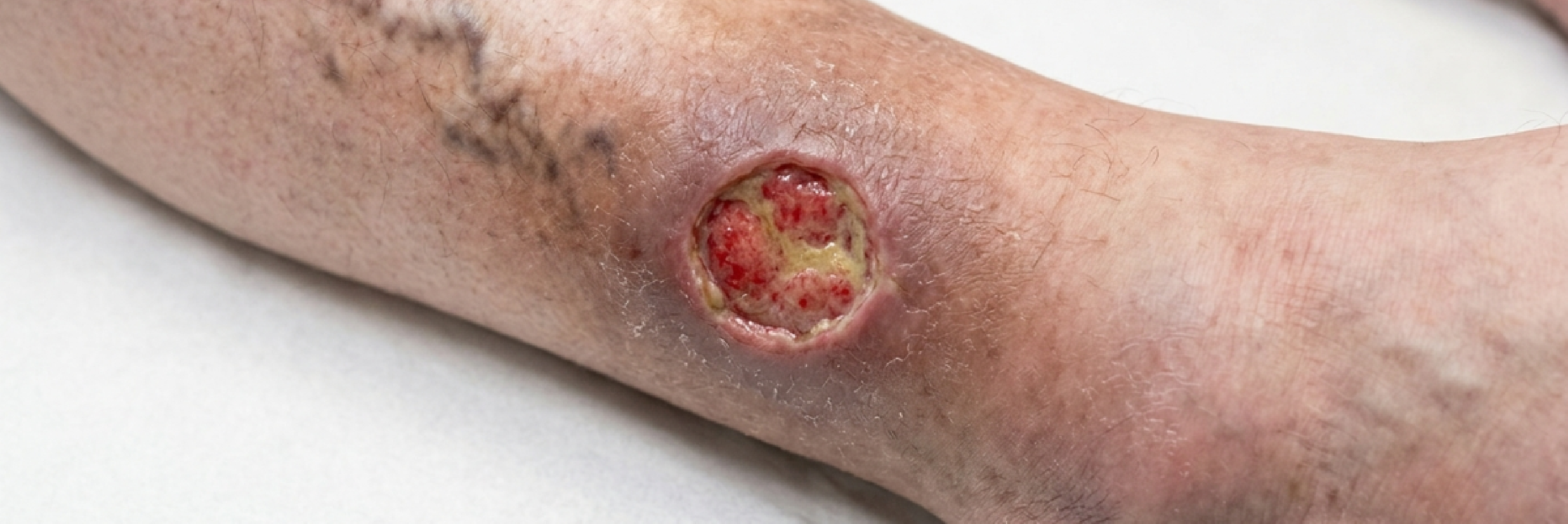 Varis Yarası (Venöz Ülser) Nedir ve Nasıl Tedavi Edilir? makalesi