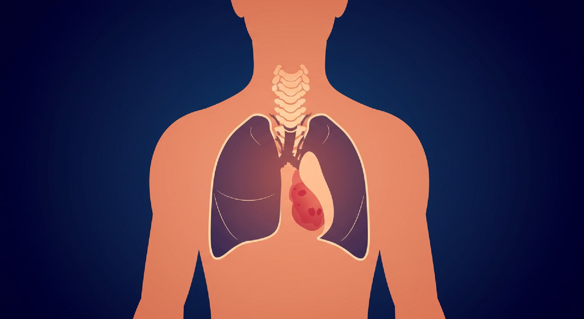 Mediastinal Tümör Tedavisinde VATS (Kapalı Göğüs Cerrahisi) Yöntemi
