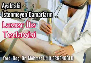 Ayaktaki istenmeyen damarların lazer ile tedavisi