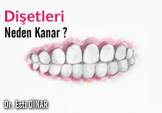 Dişetleri neden kanar?