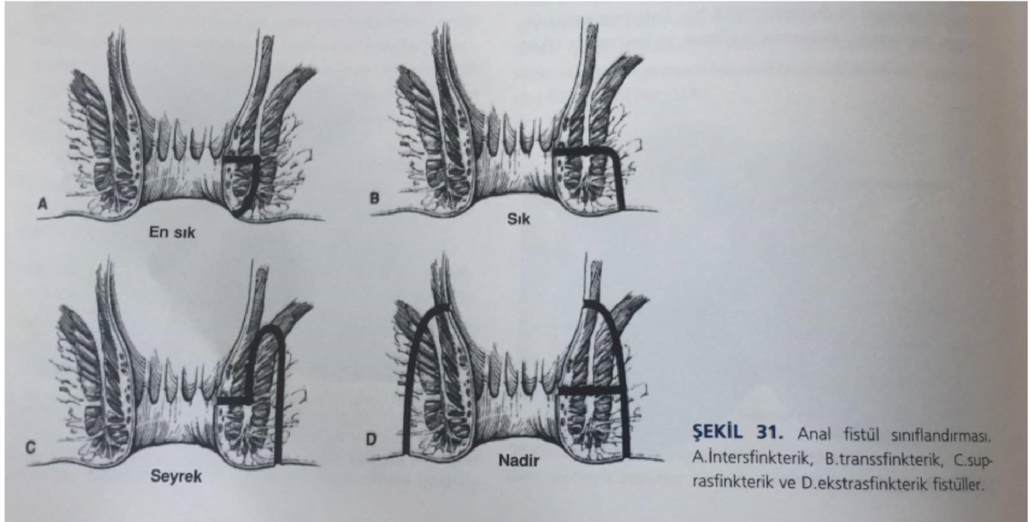 ANAL FİSTÜLLER