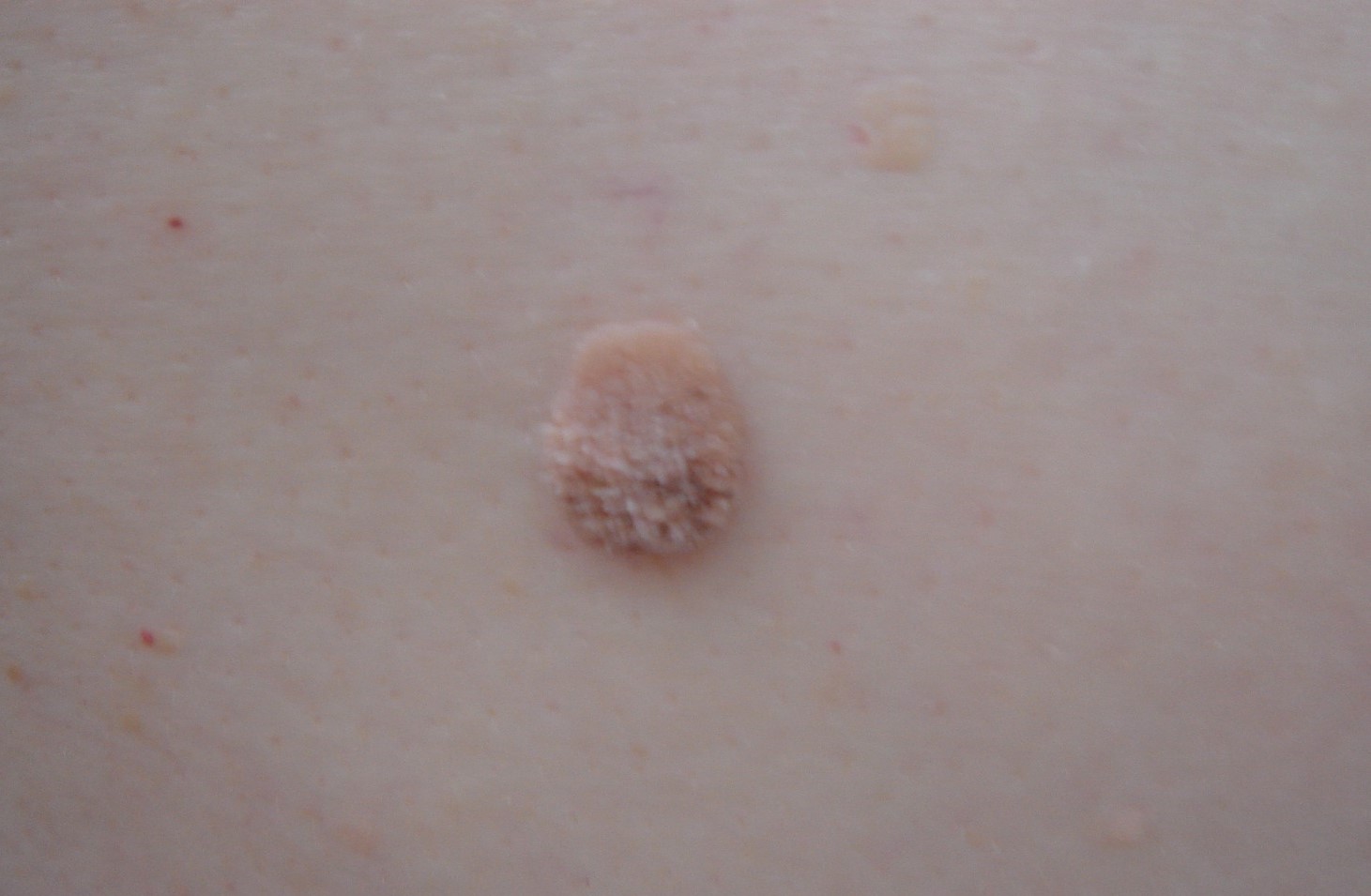 HUMAN PAPİLLOMA VİRÜS YANİ HPV NEDİR? HPV AŞILARI İLE İLGİLİ BİLGİLER