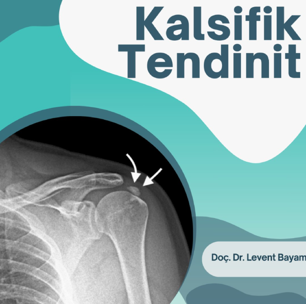 Kalsifik Tendinit makalesi