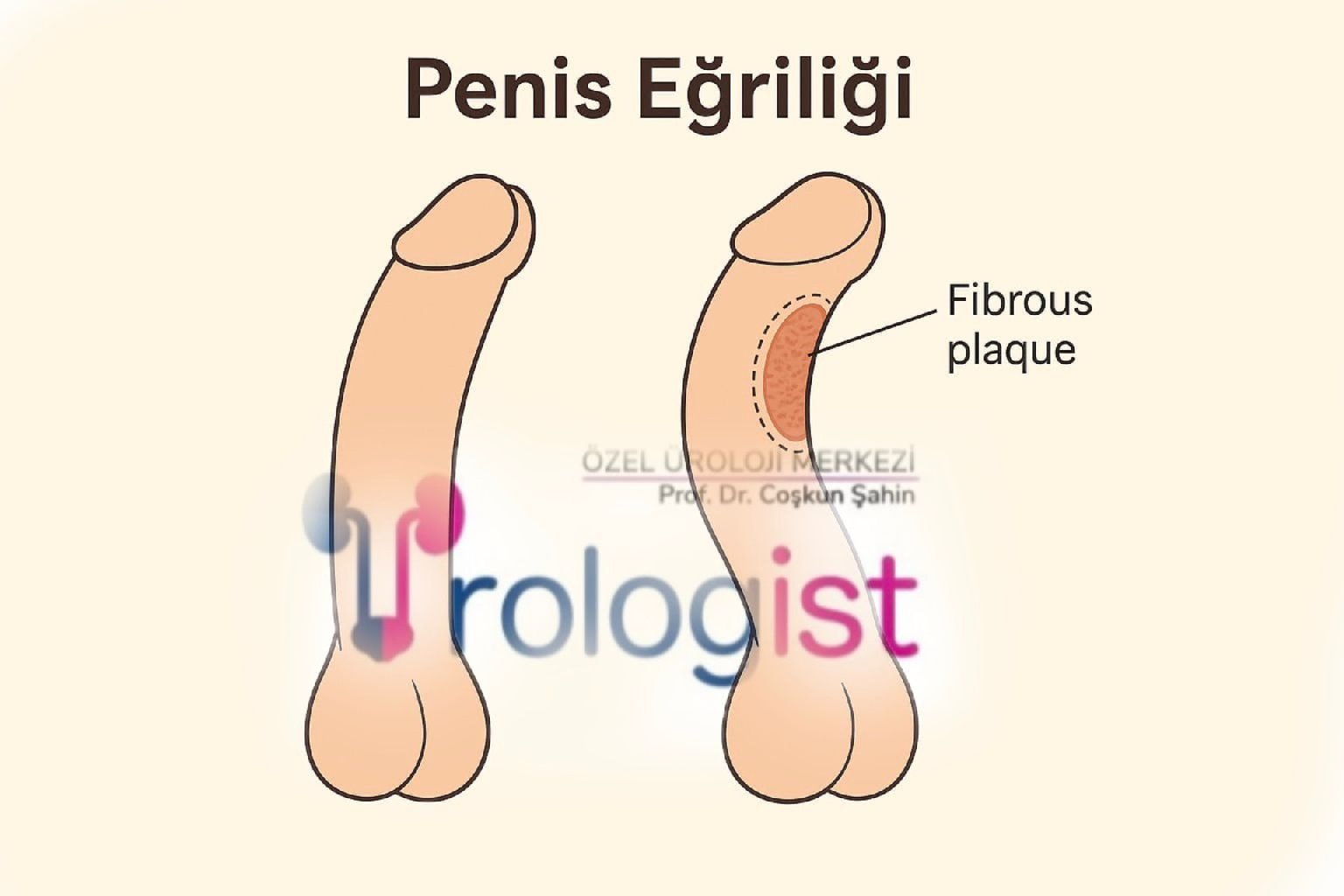 PENİS EĞRİLİĞİ nedir? Cinsel hayatı etkiler mi? Tanı ve tedavisi mümkün mü?