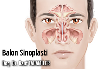 Balon Sinoplasti