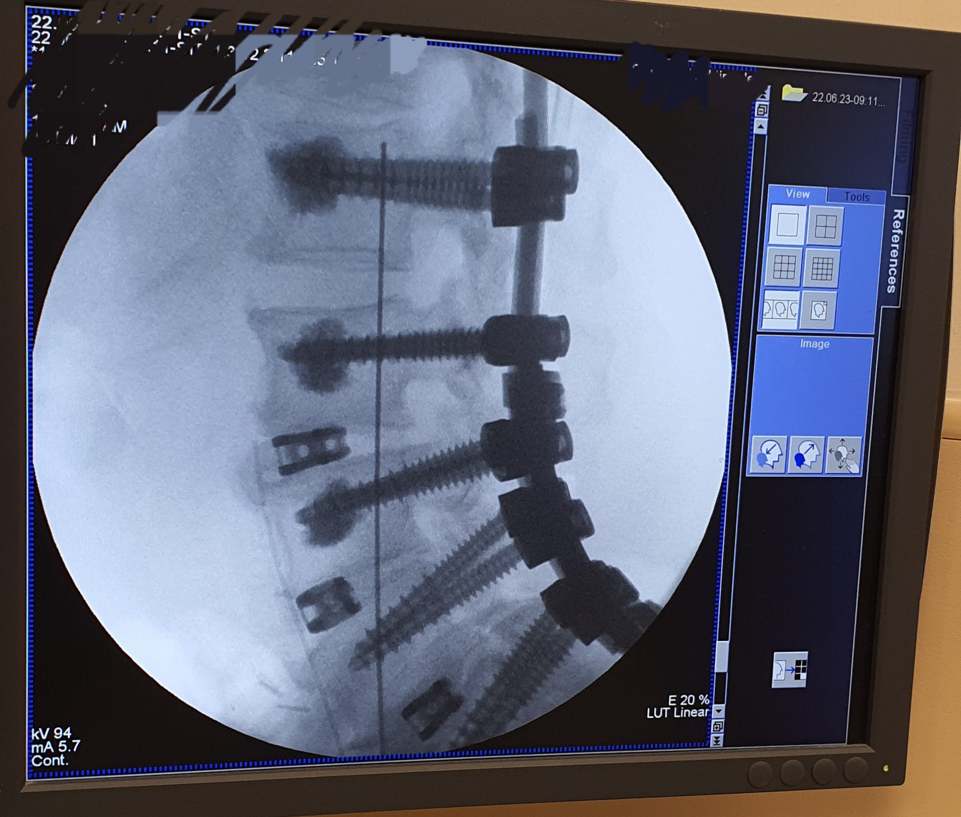 Vidalı Omurga Ameliyatı nedir? Spinal Enstrümantasyon ve Spinal Füzyon Nedir?