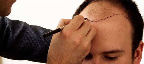 Follicular Unit Extraction - Fue Saç Ekiminde Alternatif Bir Yaklaşım