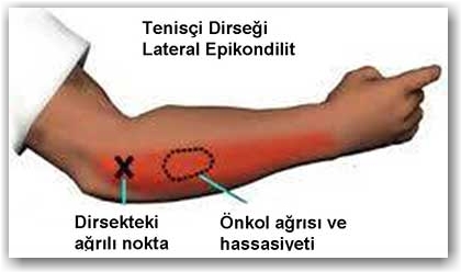 TENİSCİ DİRSEĞİ
