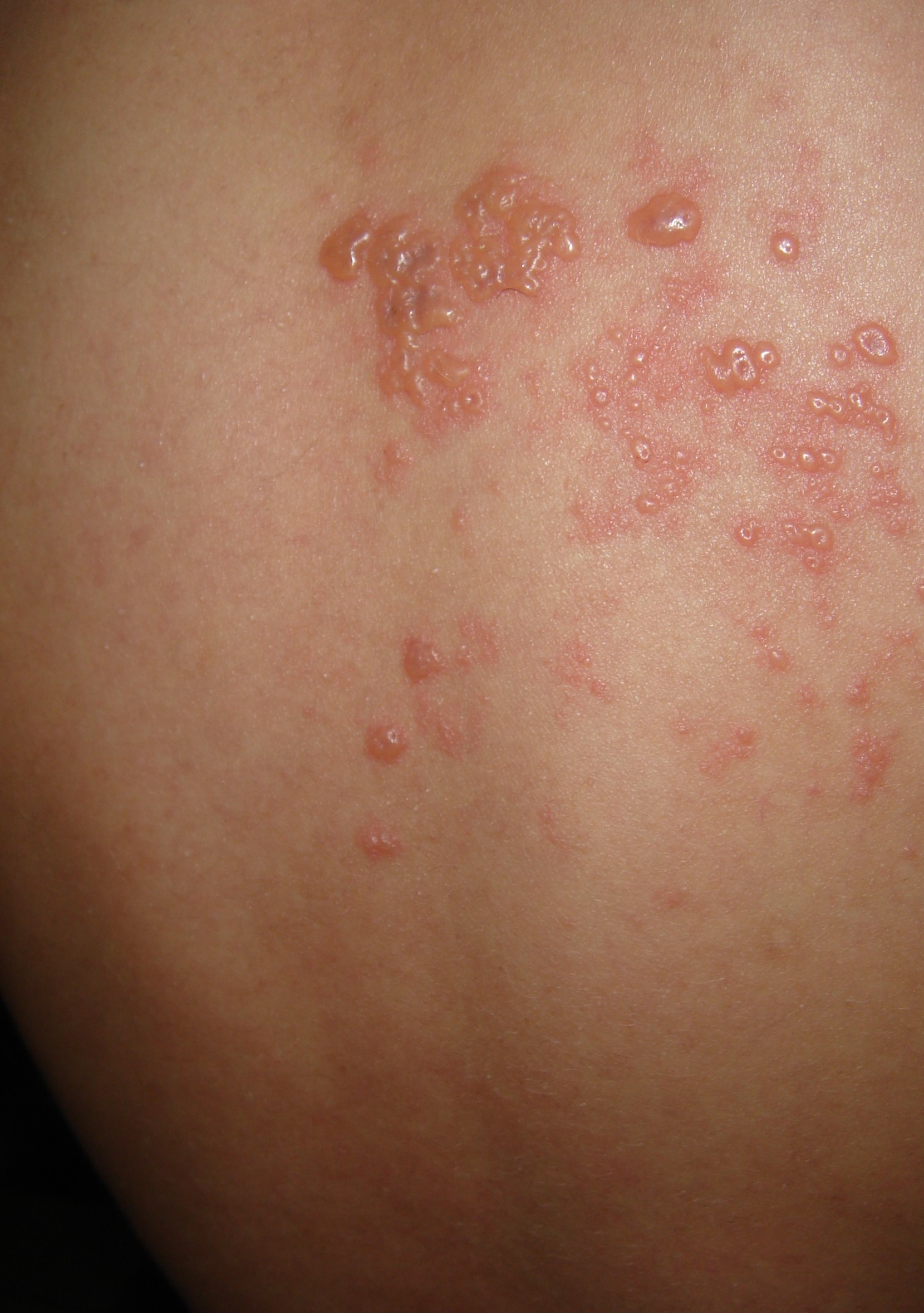 HERPES ZOSTER, ZONA VEYA HALK DİLİNDE GECE YANIĞI