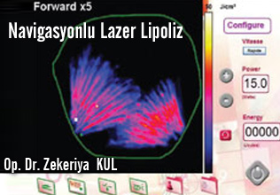 Navigasyonlu lazer lipoliz; lipocontrol