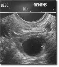 Yumurtlamanın artırılması (Kontrollü Over Stimülasyonu)