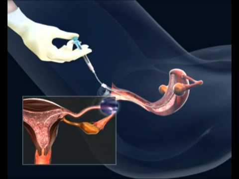 İntrauterin inseminasyon (aşılama tedavisi)