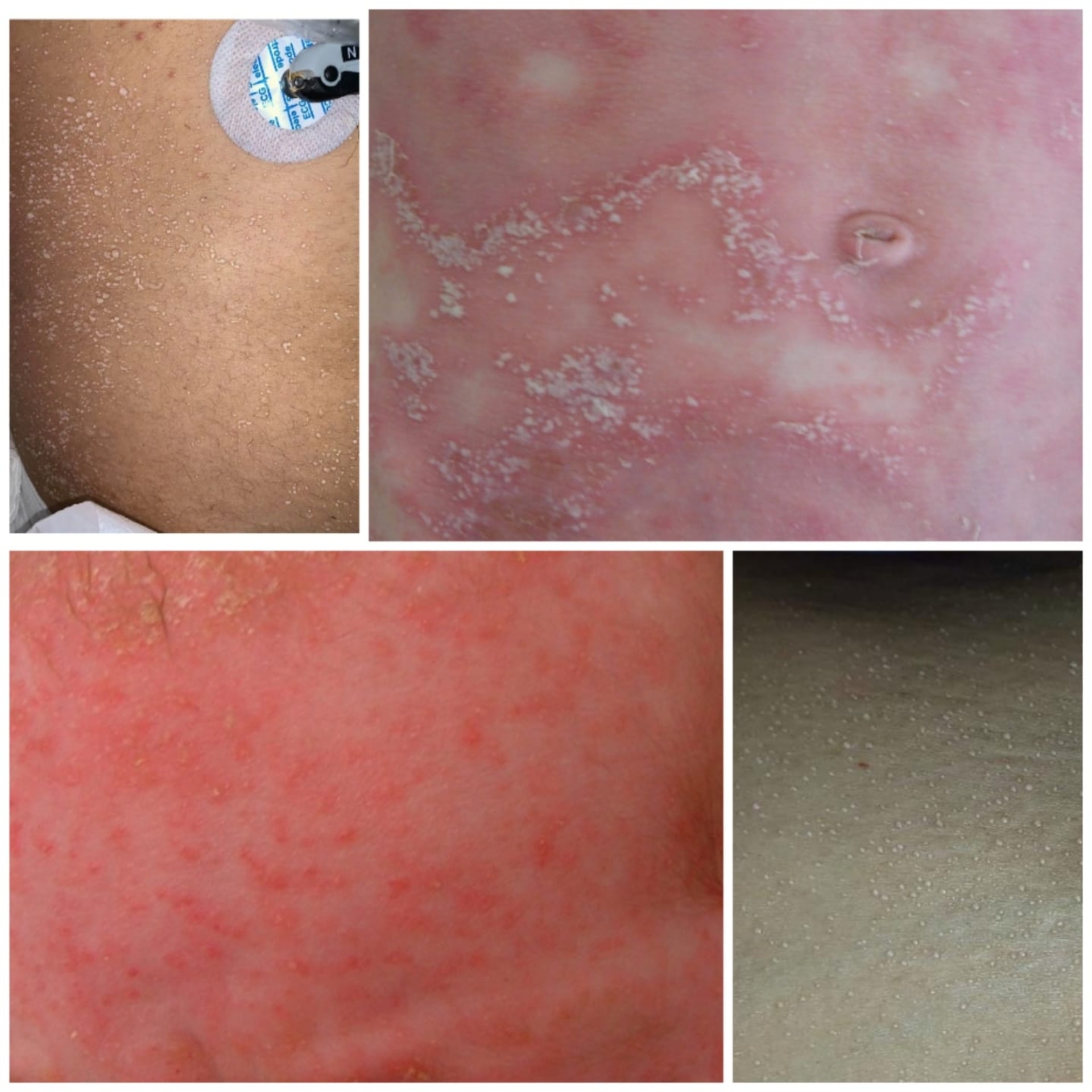 Miliaria yani İSİLİK