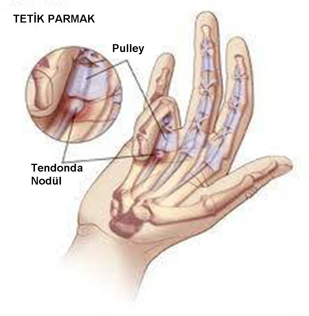 Tetik parmak