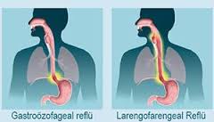 Gastroözefageal Reflu-Larengofarengeal Reflü Hastalığı- Mide Asidinin Boğaza ve Ağıza Gelmesi-Mide Asidi Regürjitasyonu