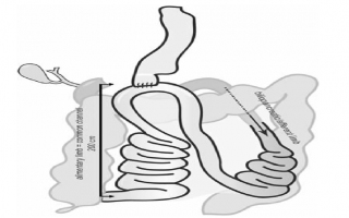 Obezite ve metabolizma cerrahisinde yeni ve umut vaadeden teknik: proksimal duodenal ileal end-to-side bypass + sleeve gastrektomi