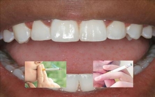 SİGARA ÖNCE DİŞLERİ ETKİLİYOR