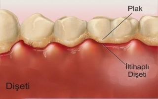 SAĞLIĞIMIZI TEHDİT EDEN GİZLİ HASTALIK; DİŞETİ HASTALIKLARI
