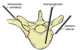 Omurga İğne Biyopsisi